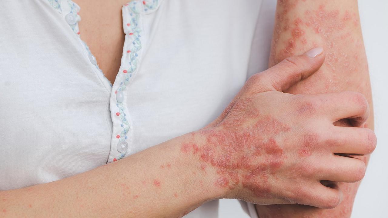 Lupus hastalığı nedir, belirtileri nelerdir? Tedavisi var mıdır? Ölüm oranı nedir?