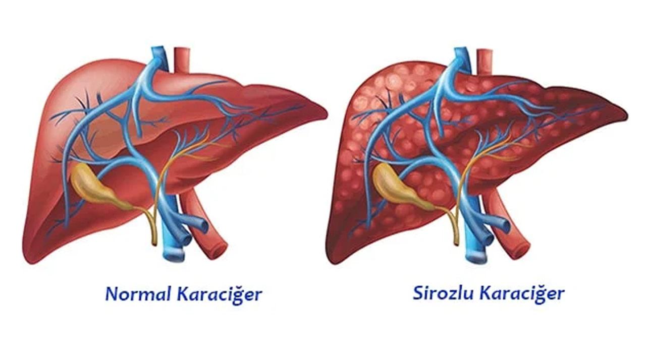 Siroz hastalığı belirtileri nelerdir? Siroz hastalığı bulaşıcı mıdır? Siroz neden olur?