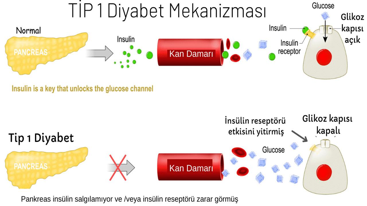 Tip 1 diyabet nedir, neden olur? Diyabet tip 1 belirtileri nelerdir?