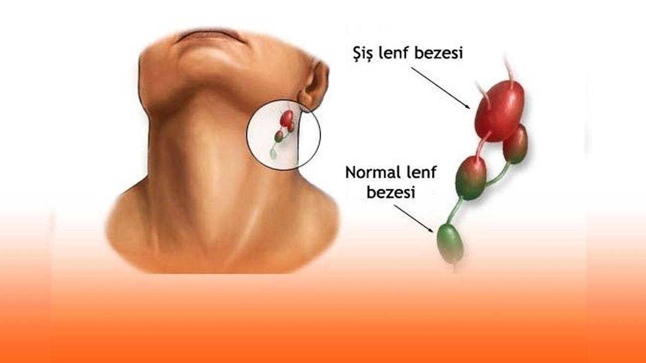 Lenf kanseri nedir, neden olur?<a class=