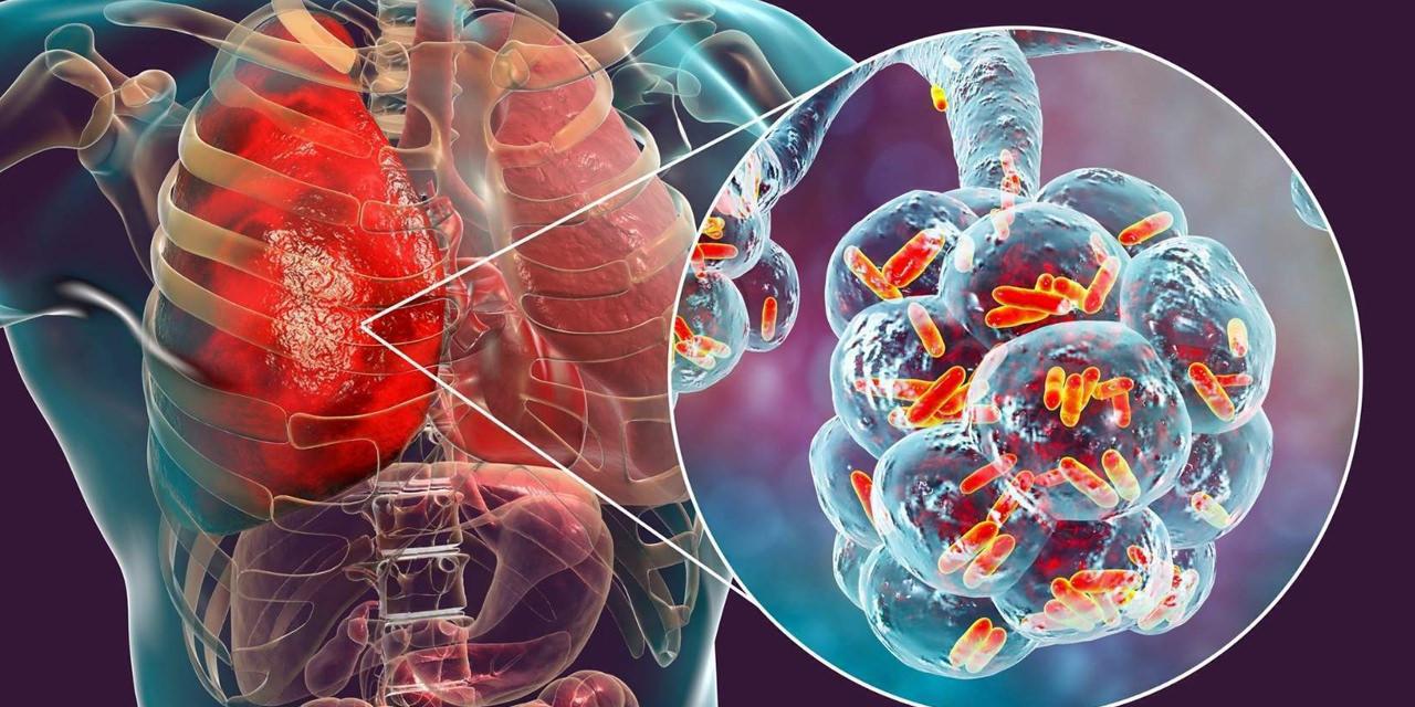 Klima ile bulaşan lejyoner hastalığı nedir, belirtileri nelerdir? Lejyoner hastalığı tedavisi
