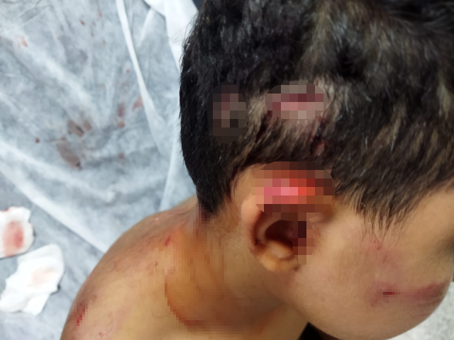 Gaziantep'te köpeğin saldırdığı çocuk ölümden döndü! Kafasına 25 dikiş atıldı
